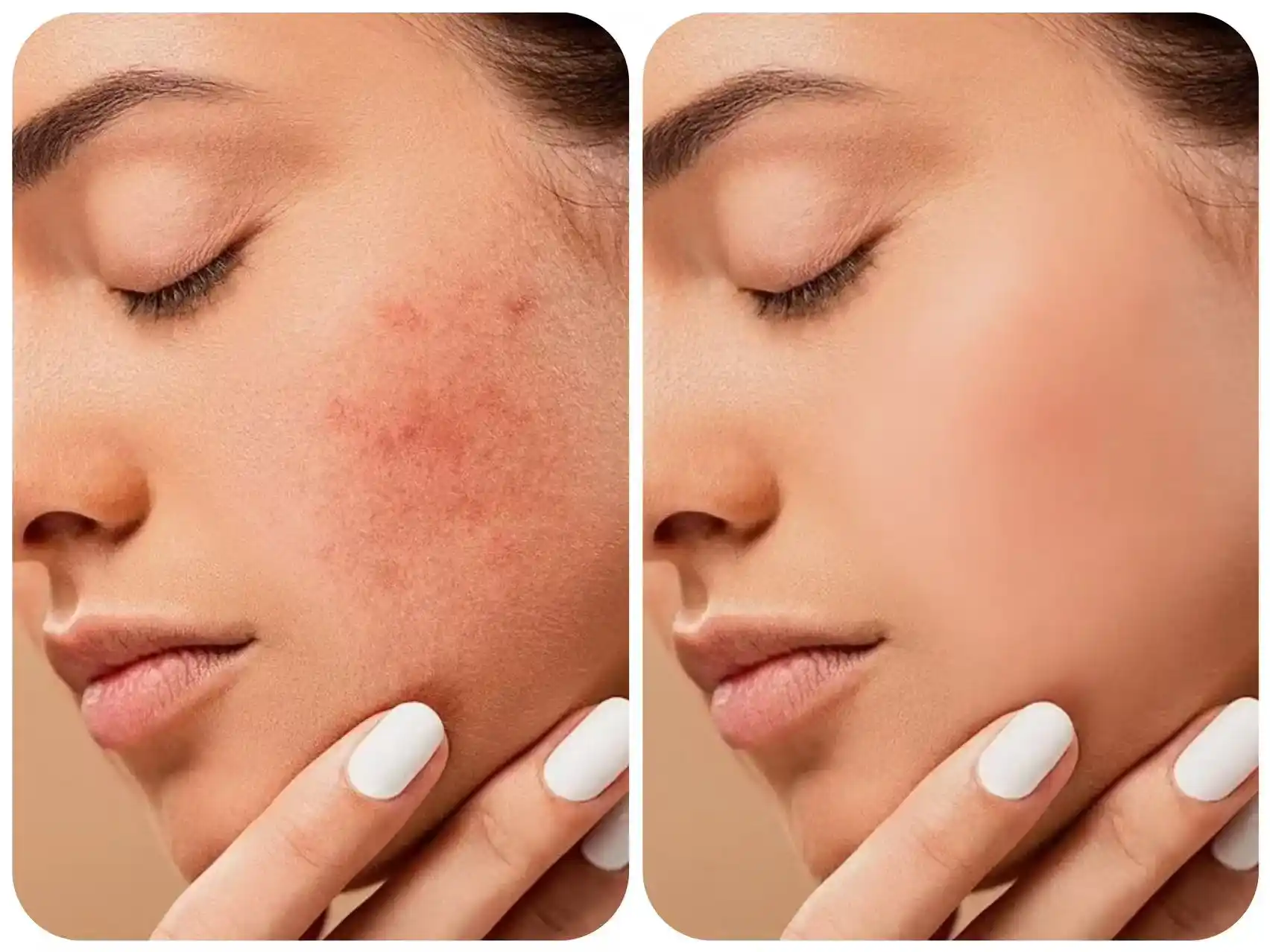 Try AI Inpainting to Fix Minor Skin Flaws